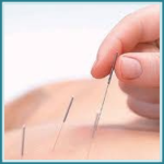 Acupuntura